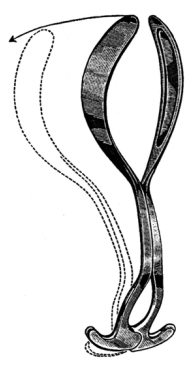 Laufe Divergent Obstetrical Forceps solid blade 31.5cm