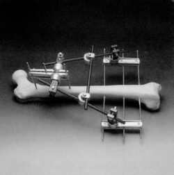 Simple Triangular Frame for Femur