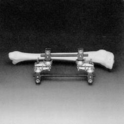 Universal Double Frame for Tibia
