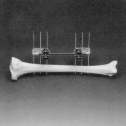 Simple Unilateral Frame for Tibia Elastic Fixation