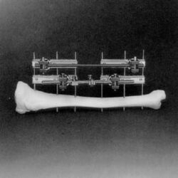 Universal Double Frame for Tibia