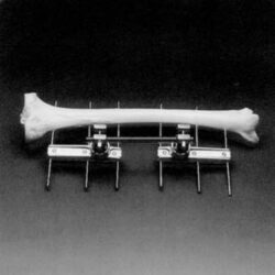 Simple Unilateral Frame Elastic Fixation