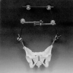 Trapezoidal Frame for Pelvis