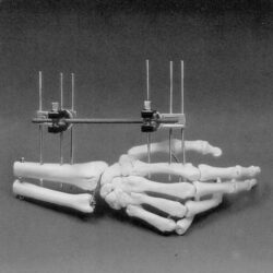 Simple Distal Radius Frame